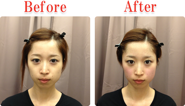 小顔美顔矯正法Before ＆ After