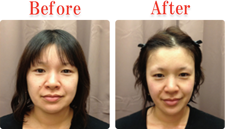 小顔美顔矯正法Before ＆ After