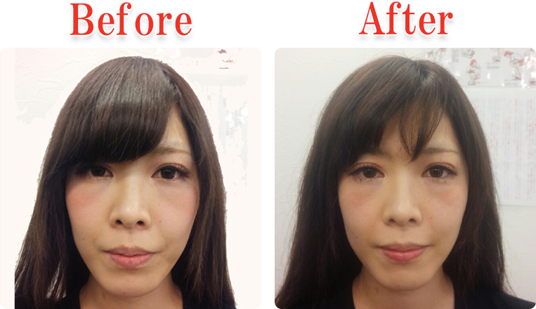 小顔美顔矯正法Before ＆ After