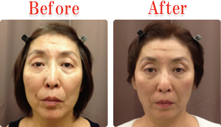 小顔美顔矯正法Before ＆ After