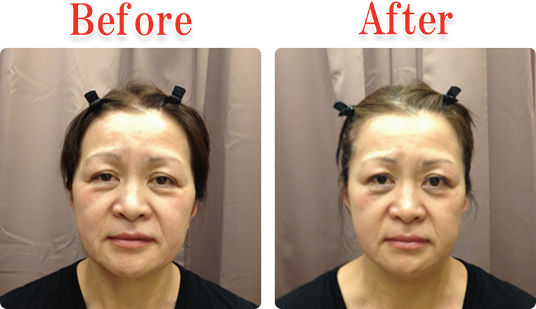 小顔美顔矯正法Before ＆ After